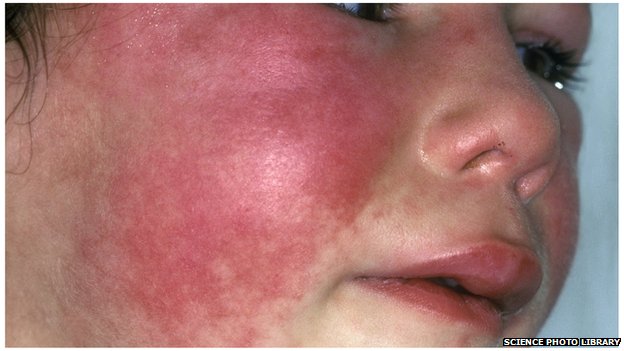 Scarlet Fever Condition, Treatments, and Pictures for ...